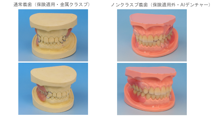 ノンクラスプデンチャー・通常義歯との比較